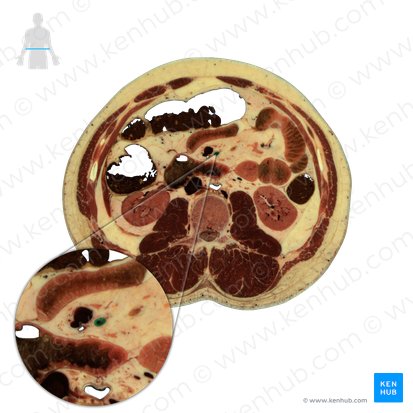 Inferior mesenteric artery (Arteria mesenterica inferior); Image: National Library of Medicine