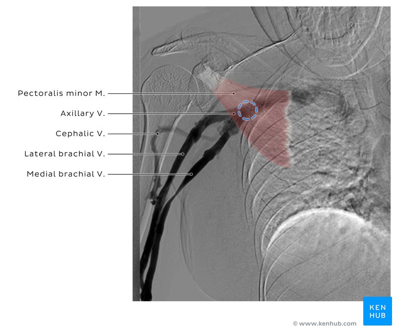 Occlusion of the axillary vein - dynamic venography