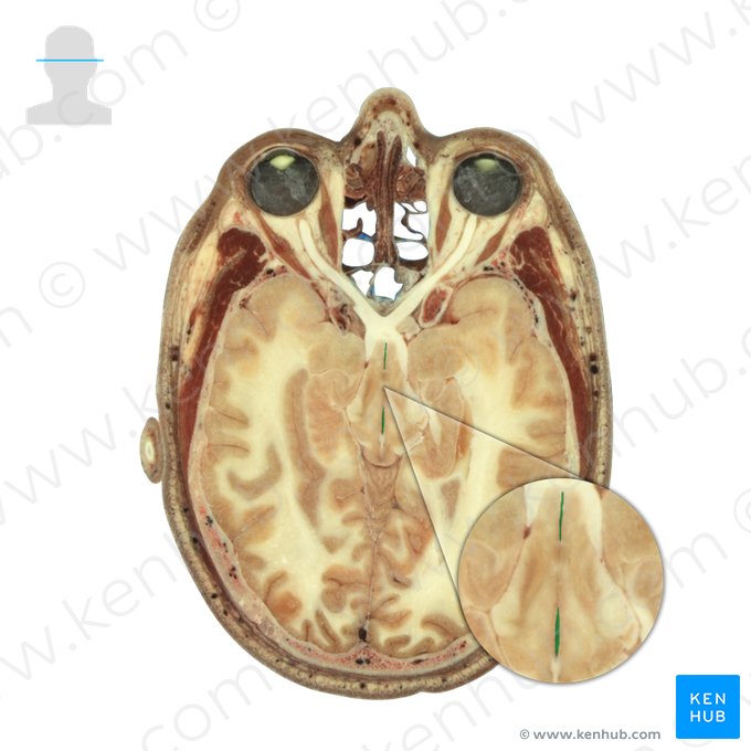 Third ventricle (Ventriculus tertius); Image: National Library of Medicine