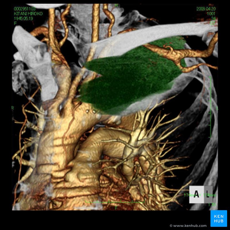 Invasive first rib tumor - Axial CT reconstruction