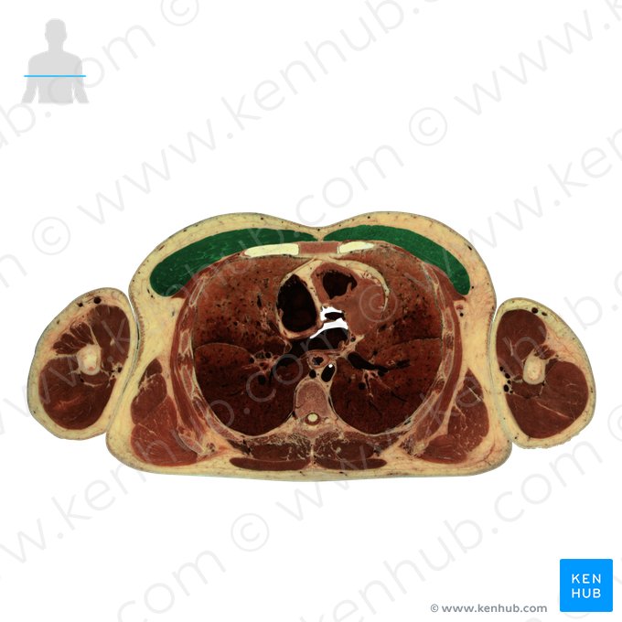 Pectoralis major muscle (Musculus pectoralis major); Image: National Library of Medicine