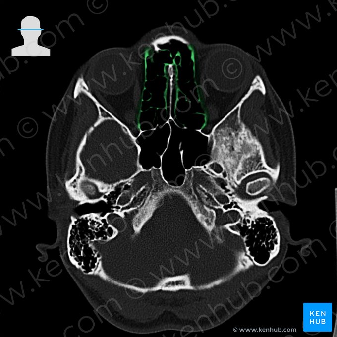 Ethmoid bone (Os ethmoidale); Image: 