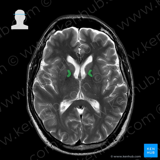 Rodilla de la cápsula interna (Genu capsulae internae); Imagen: 