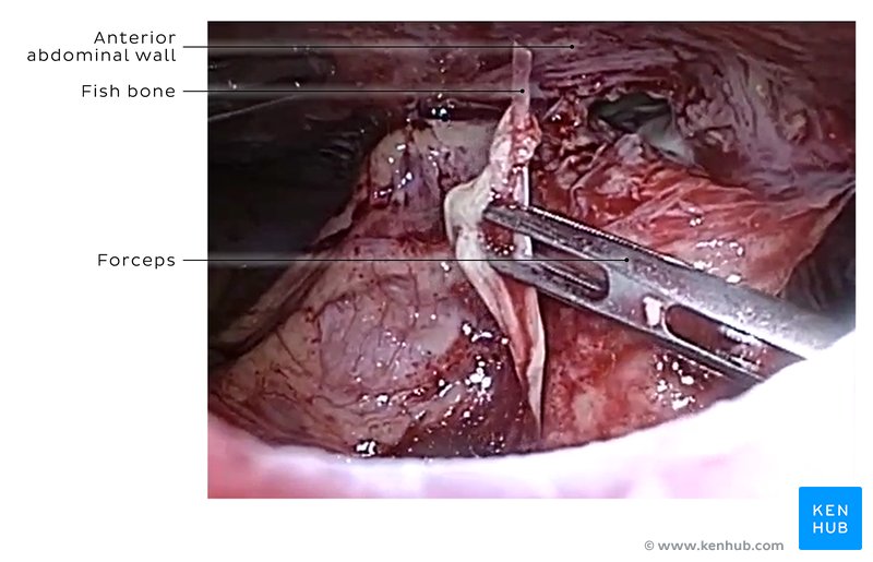 Laparoscopic surgery in the anterior abdominal wall