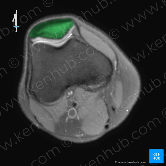 Patella; Image: 