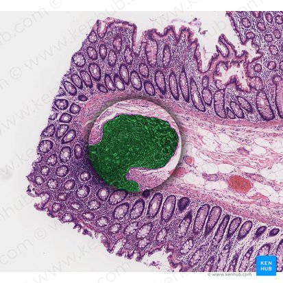 Lymphoid nodule (Nodulus lymphoideus); Image: 