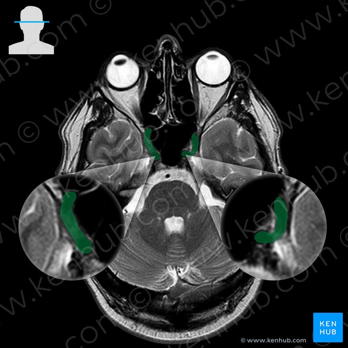 Arteria carótida interna (Arteria carotis interna); Imagen: 