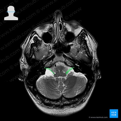 Nervio vestibulococlear (Nervus vestibulocochlearis); Imagen: 