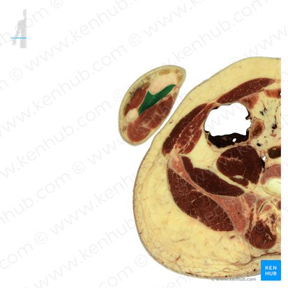 Pronator quadratus muscle (Musculus pronator quadratus); Image: National Library of Medicine