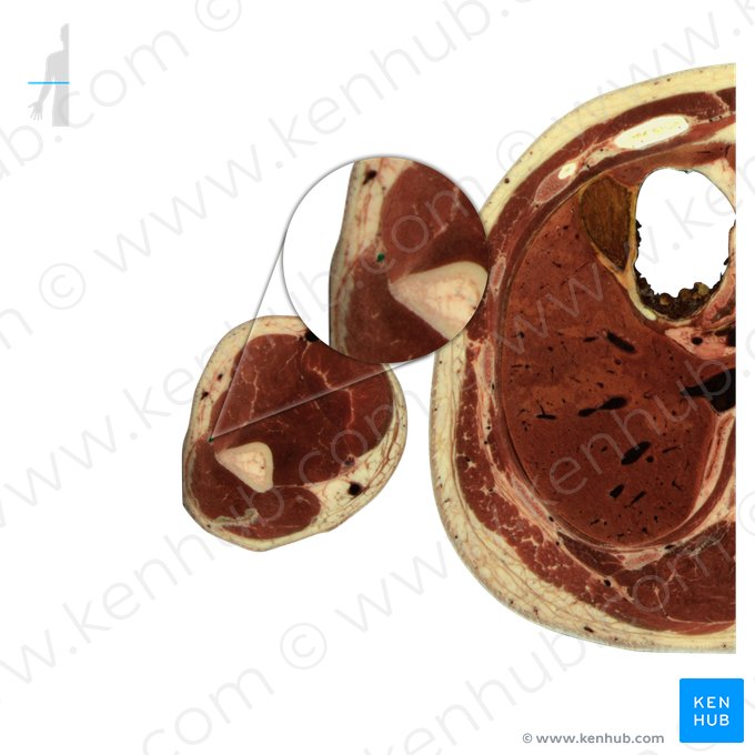 Arteria collateralis radialis (Seitliche Speichenarterie); Bild: National Library of Medicine