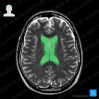 Ventrículo lateral (Ventriculus lateralis); Imagen: 