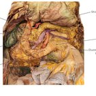 Clinical case: Duplication of the duodenum