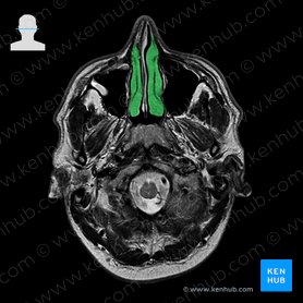 Concha nasal inferior (Concha nasalis inferior); Imagem: 