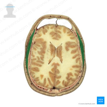 Temporalis muscle (Musculus temporalis); Image: National Library of Medicine