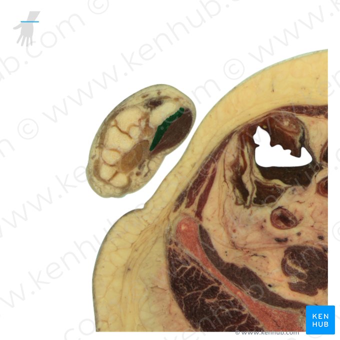 Caput profundum musculi flexoris pollicis brevis (Tiefer Kopf des kurzen Daumenbeugers); Bild: National Library of Medicine