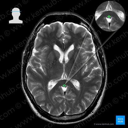 Great cerebral vein (Vena magna cerebri); Image: 