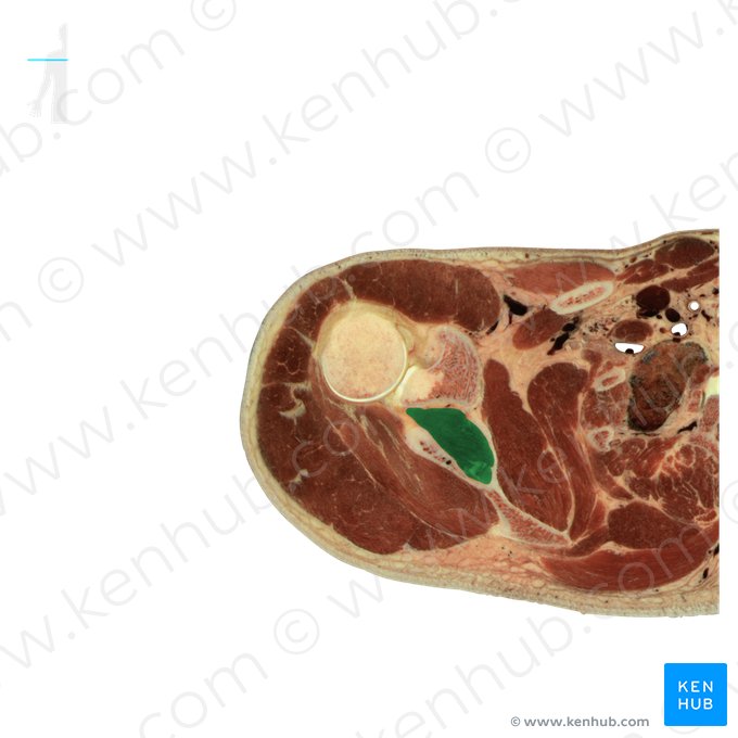 Supraspinatus muscle (Musculus supraspinatus); Image: National Library of Medicine