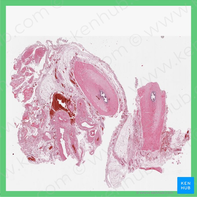 Cordón espermático (Funiculus spermaticus); Imagen: 