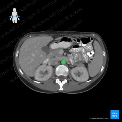 Aorta abdominalis (Bauchaorta); Bild: 