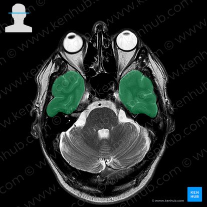 Lobus temporalis (Schläfenlappen); Bild: 