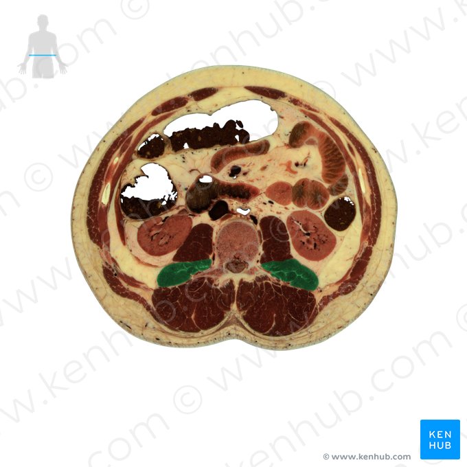 Músculo quadrado lombar (Musculus quadratus lumborum); Imagem: National Library of Medicine