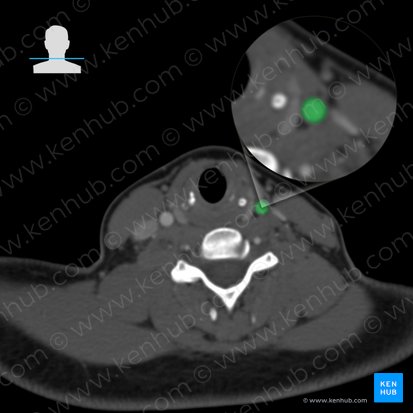 Arteria carótida común izquierda (Arteria carotis communis sinistra); Imagen: 