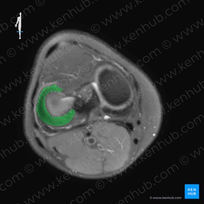 Menisco lateral (Meniscus lateralis); Imagen: 