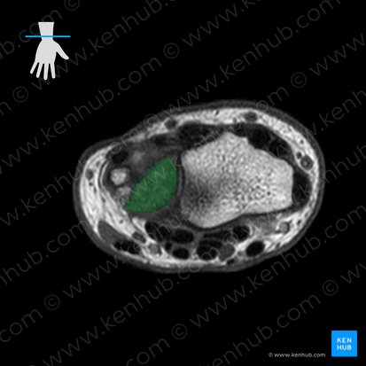 Discus articulationis radioulnaris distalis (Gelenkscheibe des distalen Radioulnargelenks); Bild: 