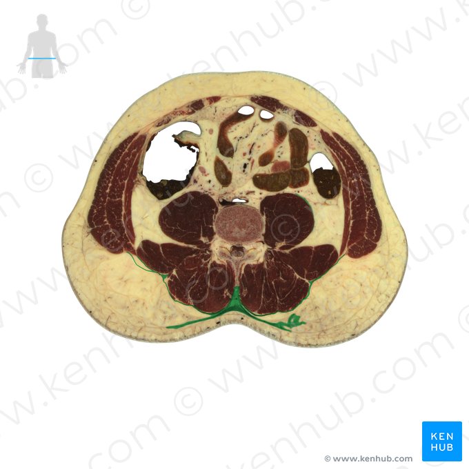 Fascia thoracolumbalis (Brust-Lenden-Faszie); Bild: National Library of Medicine