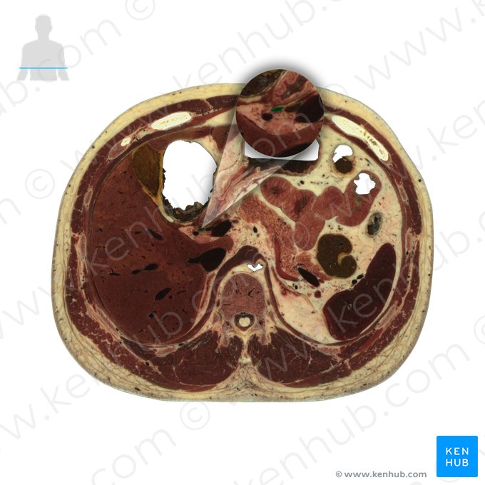 Proper hepatic artery (Arteria hepatica propria); Image: National Library of Medicine