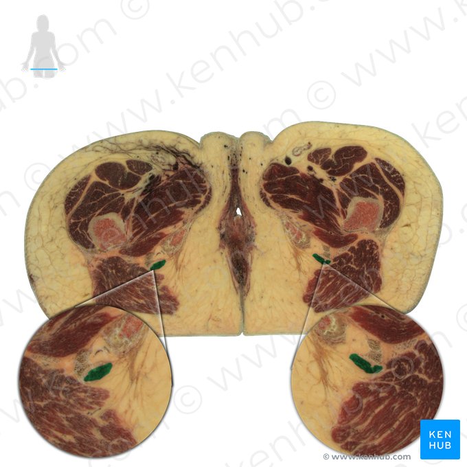 Musculus semitendinosus (Halbsehnenmuskel); Bild: National Library of Medicine