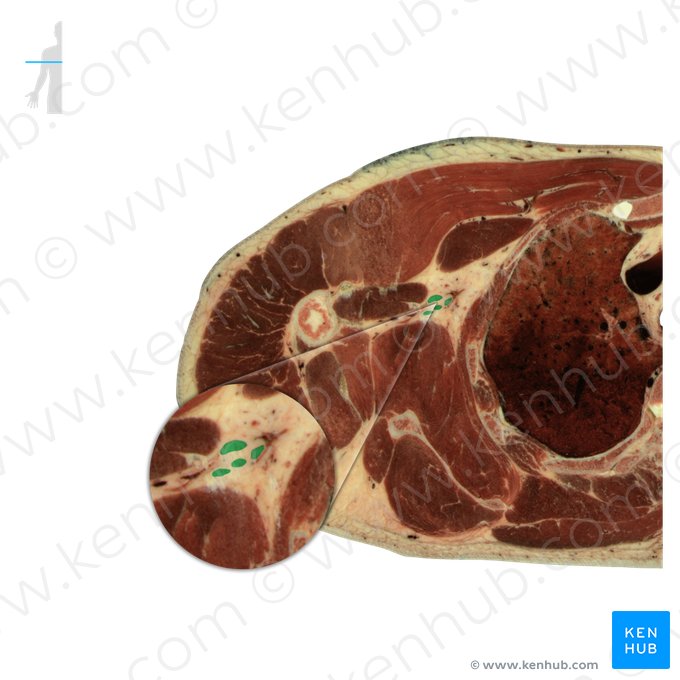 Plexus brachialis (Armgeflecht); Bild: National Library of Medicine