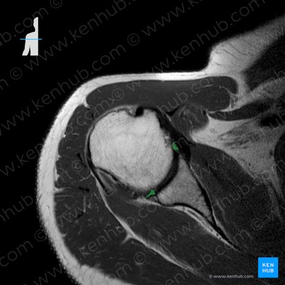 Labrum glenoideo (Labrum glenoidale scapulae); Imagen: 