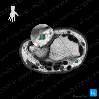 Radial artery (Arteria radialis); Image: 