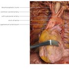 Clinical case: Chronic thoracic aneurysm