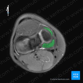 Medial meniscus (Meniscus medialis); Image: 