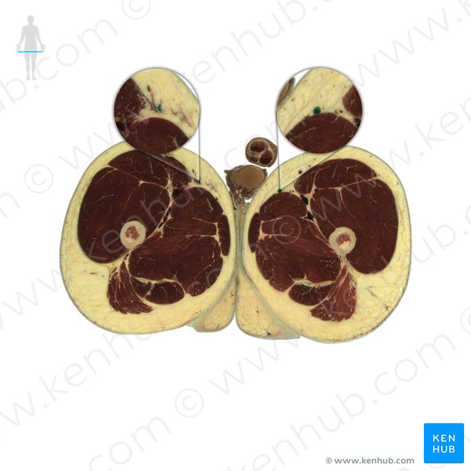 Veia safena magna (Vena saphena magna); Imagem: National Library of Medicine