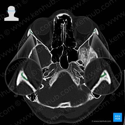 Frontozygomatic suture (Sutura frontozygomatica); Image: 