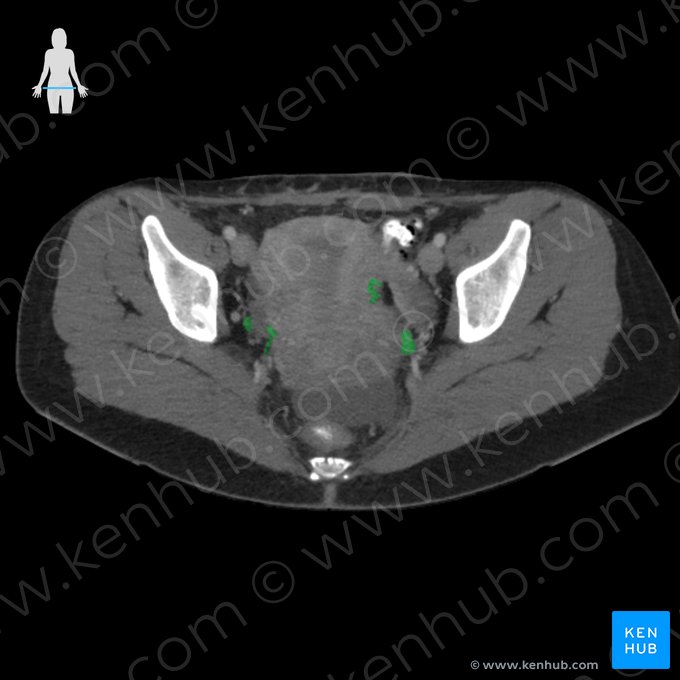 Uterine venous plexus (Plexus venosus uterinus); Image: 