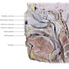 Clinical case: Schwannoma of the nasal cavity