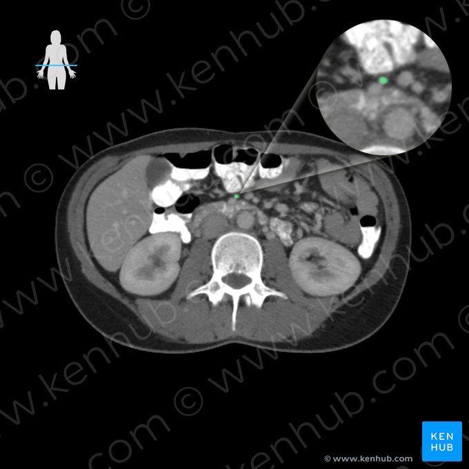 Ileocolic artery (Arteria ileocolica); Image: 