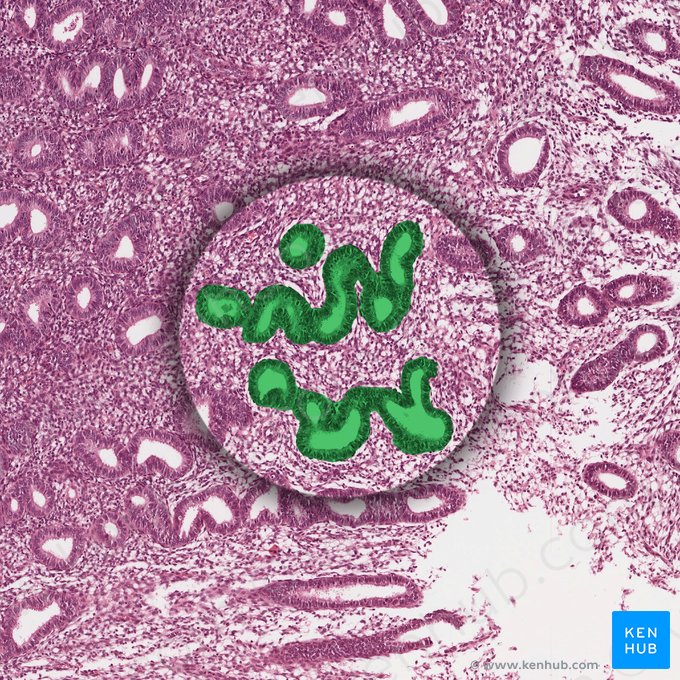 Glándulas endometriales tortuosas; Imagen: 