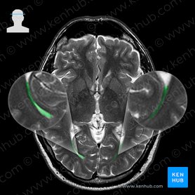 Asta occipital del ventrículo lateral (Cornu occipitale ventriculi lateralis); Imagen: 