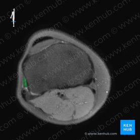 Musculus fibularis longus (Langer Wadenbeinmuskel); Bild: 
