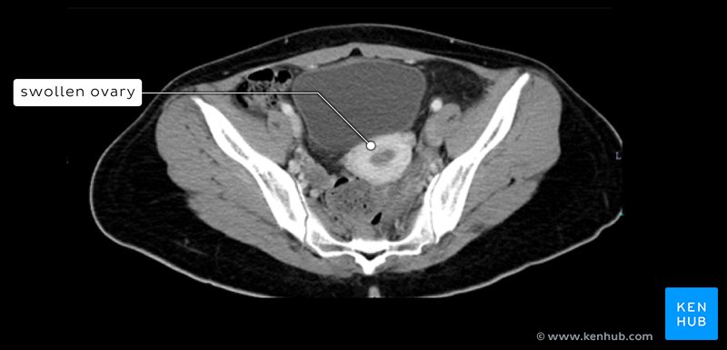 Tortured left ovary