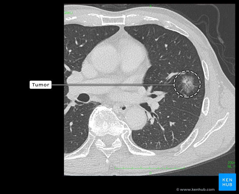 Lung tumour