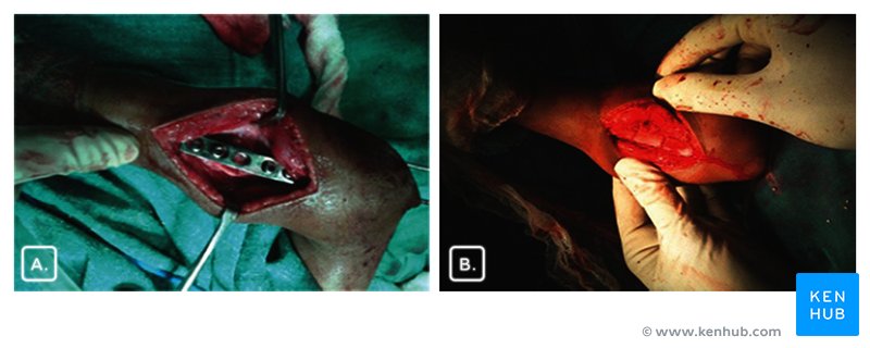 Intraoperative photograph of radius and ulna