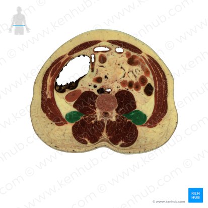 Quadratus lumborum muscle (Musculus quadratus lumborum); Image: National Library of Medicine