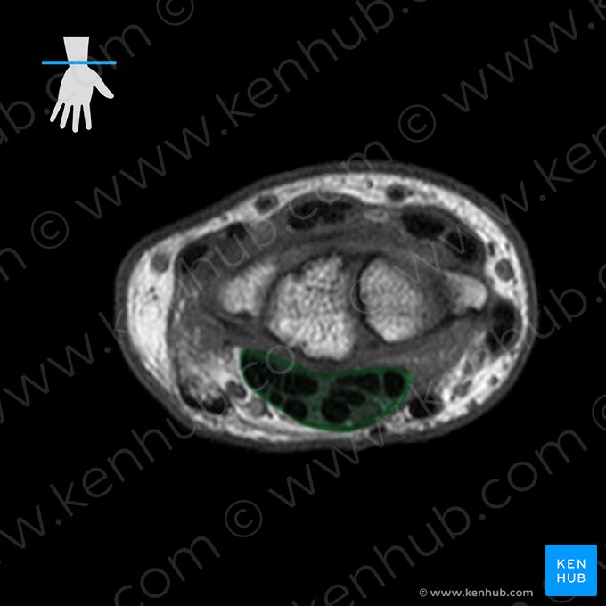 Carpal tunnel (Canalis carpi); Image: 