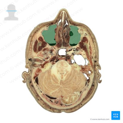 Seio maxilar (Sinus maxillaris); Imagem: National Library of Medicine